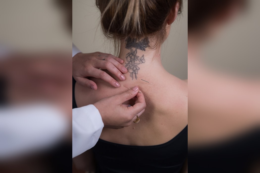 Acupuntura – Clínica Bagatini
