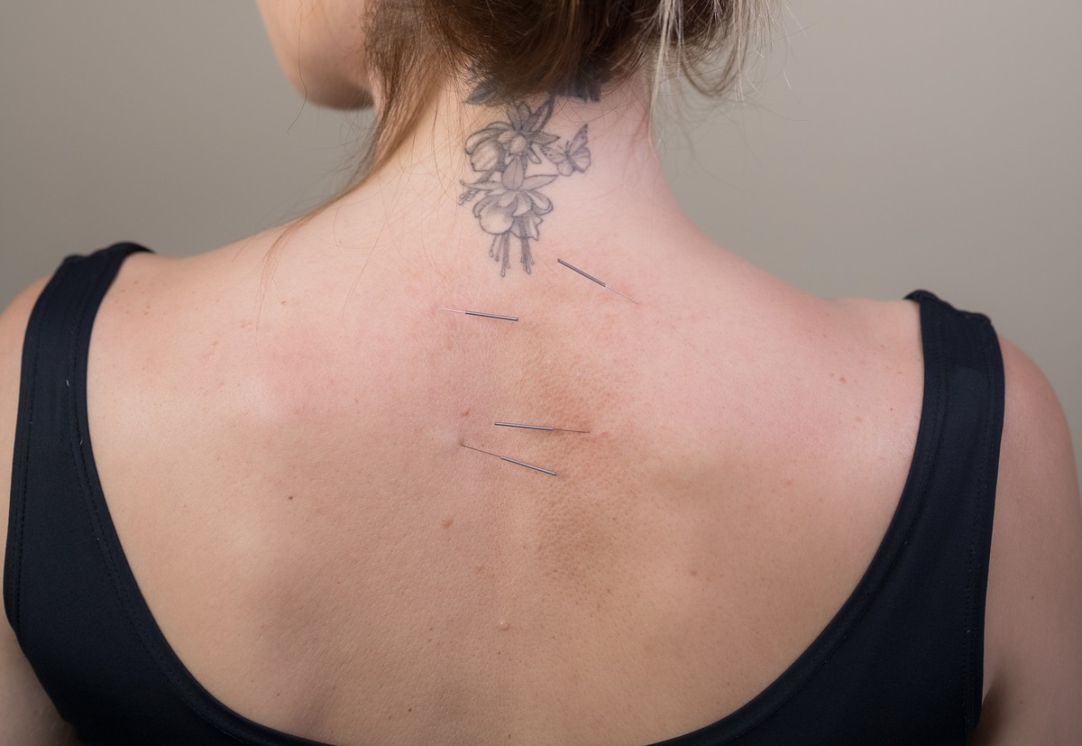 Agulhas de acupuntura aplicadas ao longo da coluna cervical e torácica na Clínica Bagatini